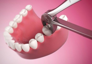 مراقبت از بعد از کشیدن دندان دائمی